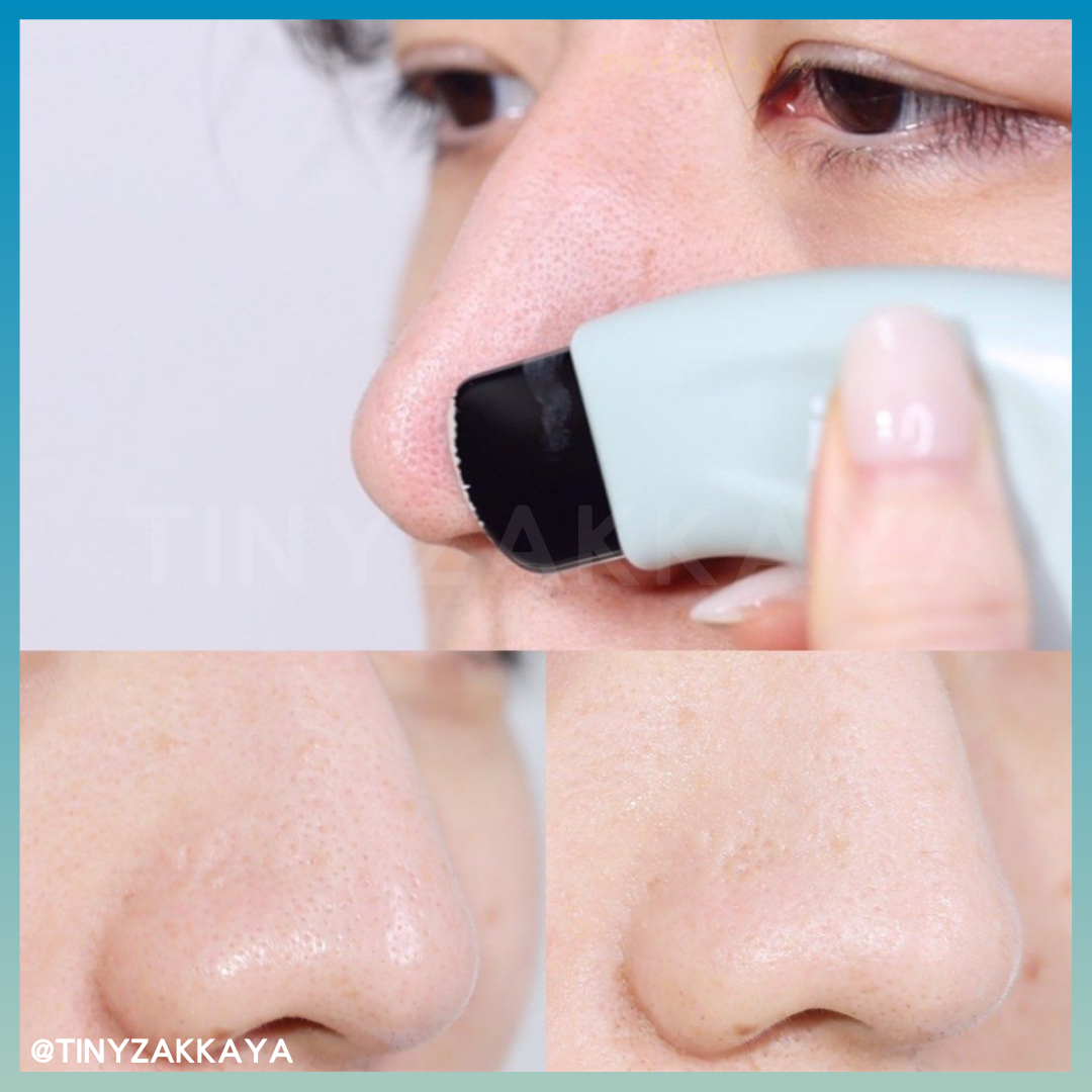 🇰🇷Korea ILSO Deep Clean Master|Apply and then scrape, blackhead-eliminating, out-of-stock | Stainless steel blackhead scraper