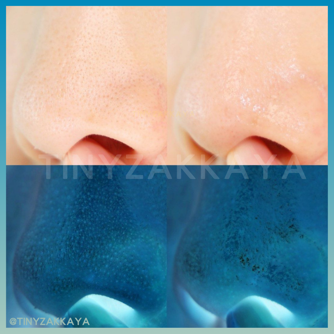 🇰🇷Korea ILSO Deep Clean Master|Apply and then scrape, blackhead-eliminating, out-of-stock | Stainless steel blackhead scraper