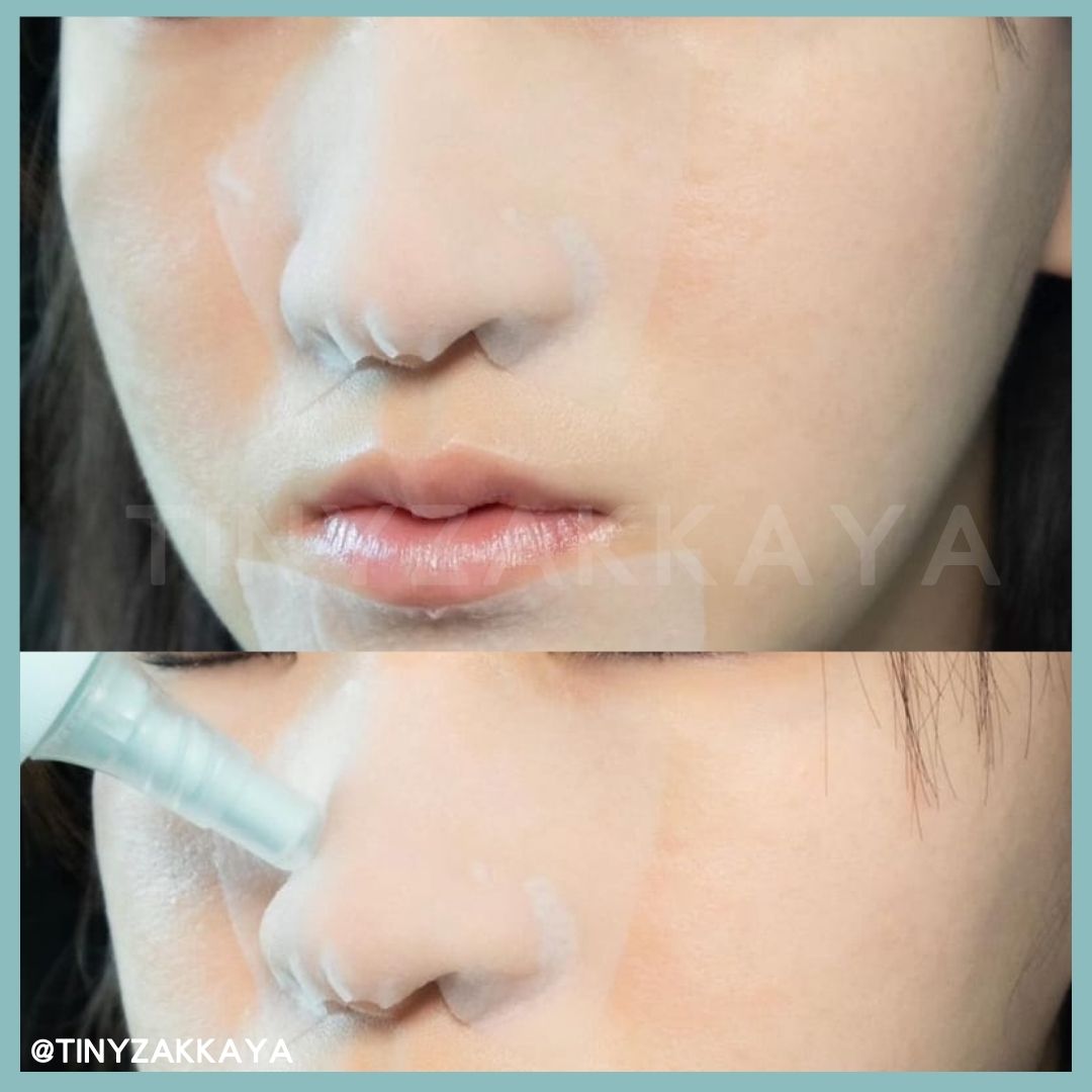 🇰🇷韓國 ILSO Super Melting Sebum Softener 150ml 黑頭粉刺導出液｜溫和無痛地溶走黑白頭、軟化老廢角質｜